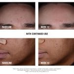 Neutrogena Stubborn Blackheads Daily Acne Facial Serum with Salicylic, Glycolic, Polyhydroxy & Mandelic Acids, Oil-Free Face Serum for Acne-Prone Skin to Help Clear Clogged Pores, 1 fl. oz - Image 4