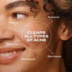 Murad Biome-Balancing Acne Treatment – Salicylic, Mandelic, and Glutamic Acid Serum for Clearing and Preventing Breakouts, Decongesting Pores, and Balancing Skin Microbiome – 1.0 Fl Oz - Image 3