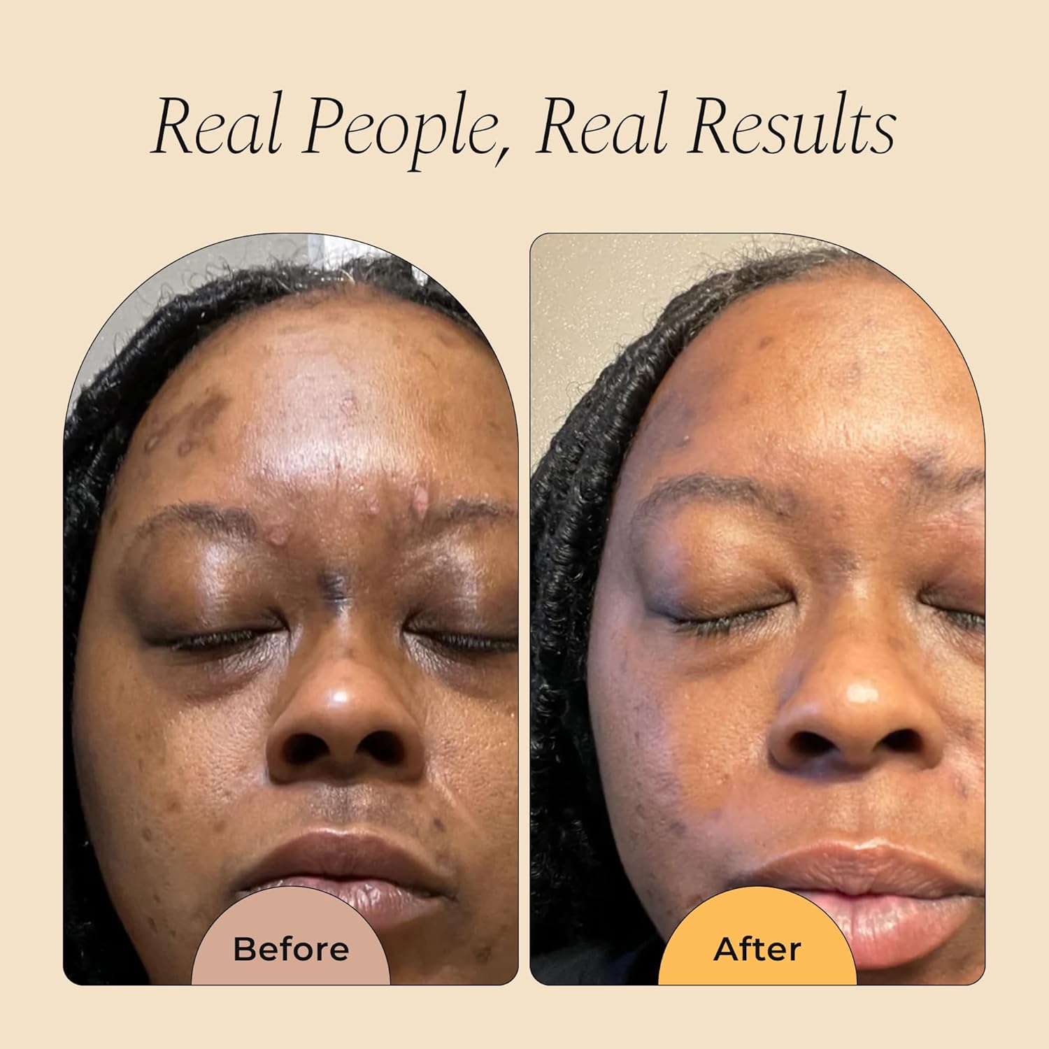 Glo Melanin Dark Spot Remover for Face - Dark Spot Corrector Serum with Vitamin C - Reduces Discoloration and Hyperpigmentation - Image 3